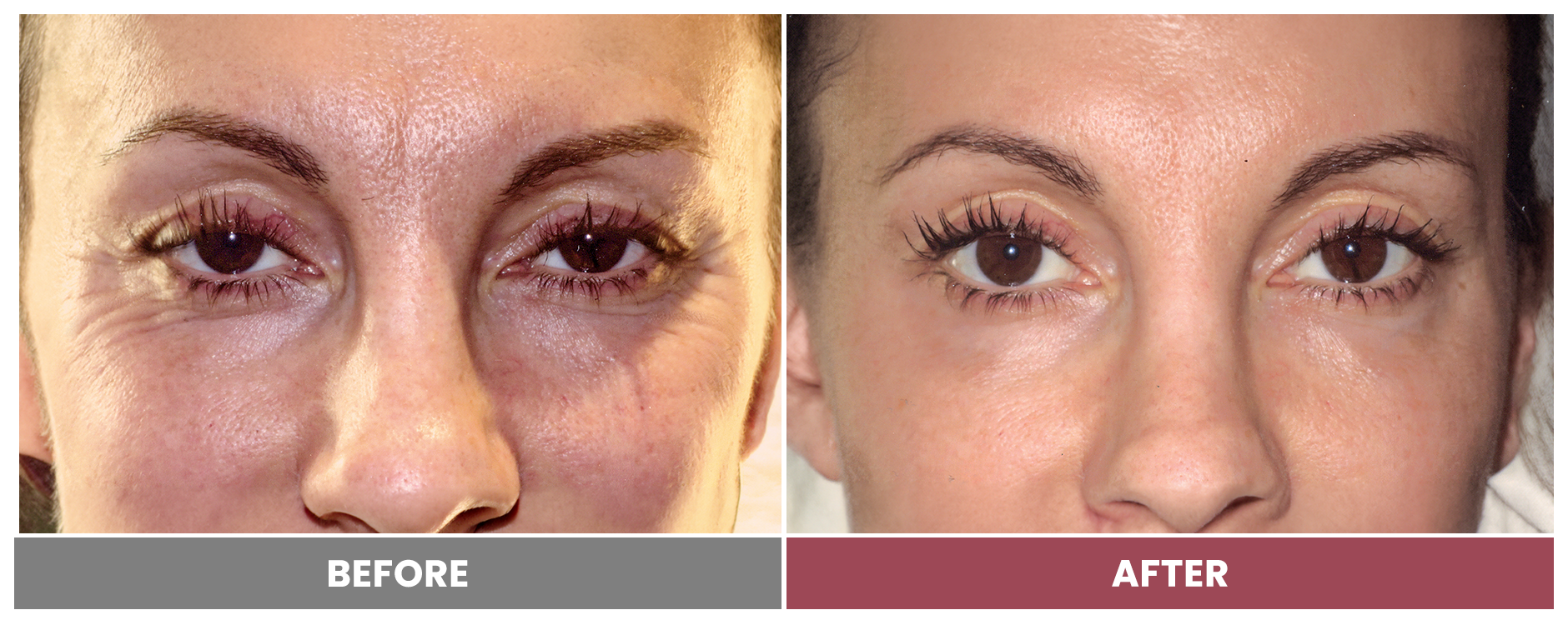 BOTOX FOR WRINKLES & BROW LIFT - Case 16